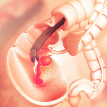 Colonoscopy in shaikpet