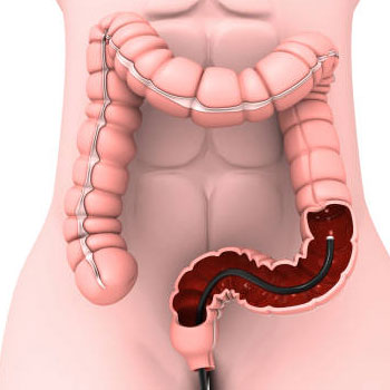 Sigmoidoscopy in Hyderabad