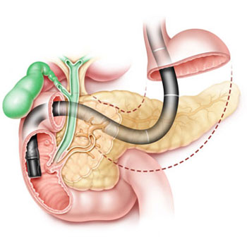 ERCP surgery in Hyderabad