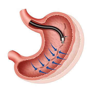 Endoscopic sleeve gastroplasty