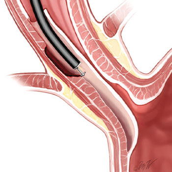 Peroral endoscopic myotomy (POEM)